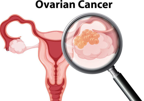 Apatinib addition to doxorubicin potential treatment option in platinum-resistant recurrent ovarian cancer