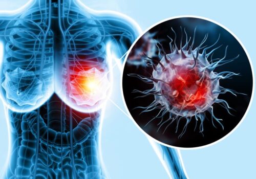 Aromatase inhibitors reduce risk of breast cancer recurrence compared to tamoxifen