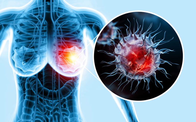 Aromatase inhibitors reduce risk of breast cancer recurrence compared to tamoxifen