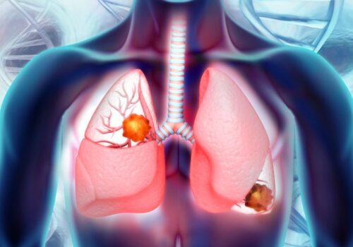 Atezolizumab (Tecentriq) approved for non-small cell lung cancer