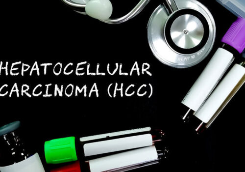 Atezolizumab anti-drug antibodies worsen survival in hepatocellular carcinoma