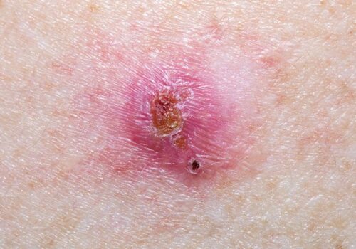 Basal cell carcinoma diagnosis improved with novel imaging technique