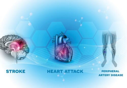 Behavioural change intervention improves walking distance in peripheral artery disease