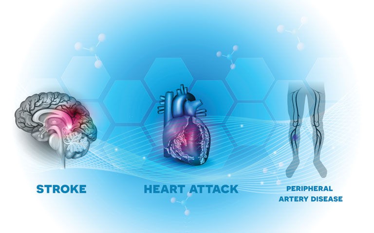 Behavioural change intervention improves walking distance in peripheral artery disease