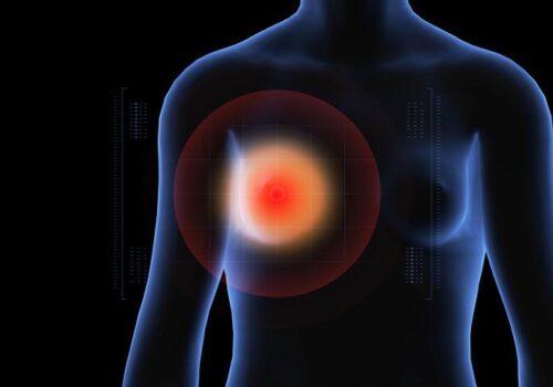 Breast tomosynthesis reduces false positive rate compared to mammography