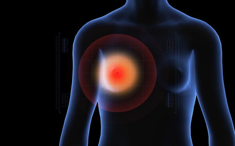 Breast tomosynthesis reduces false positive rate compared to mammography