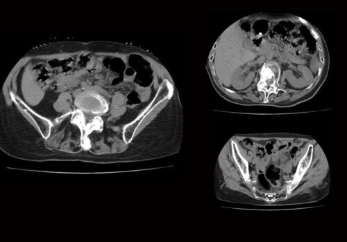 CNN model improves orthopaedic surgeons' detection of CT scan fractures