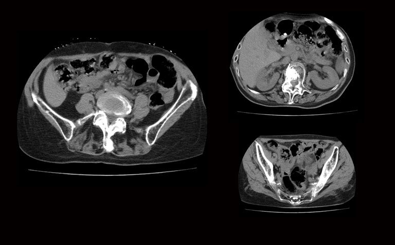 CNN model improves orthopaedic surgeons' detection of CT scan fractures