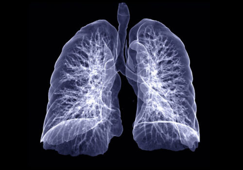 CT chest reveals fewer cases of pneumonia in breakthrough COVID-19 infections