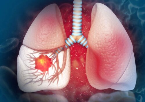 Canakinumab fails to improve disease-free survival in non-small cell lung cancer
