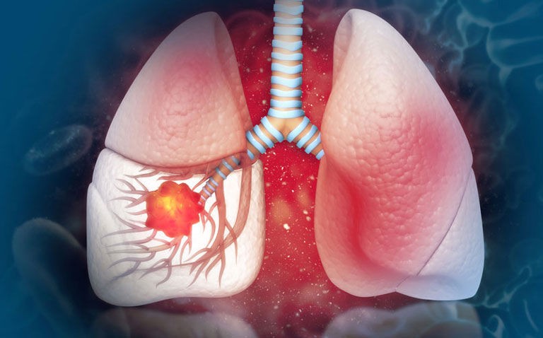 Canakinumab fails to improve disease-free survival in non-small cell lung cancer