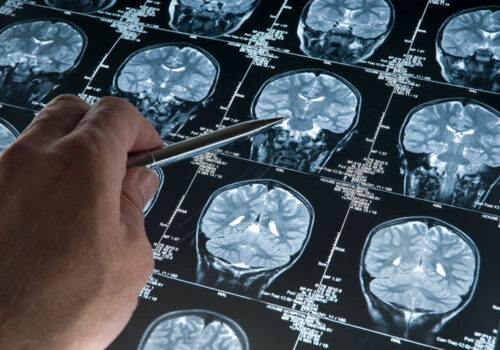 Choroid plexus volume and permeability potential MRI imaging markers for Alzheimer's disease