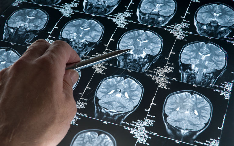 Choroid plexus volume and permeability potential MRI imaging markers for Alzheimer's disease