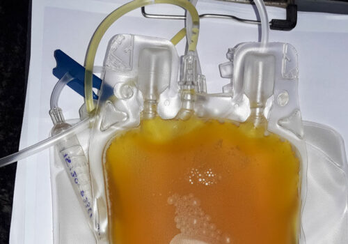 Convalescent plasma use reduces hospitalisation in unvaccinated COVID-19 patients