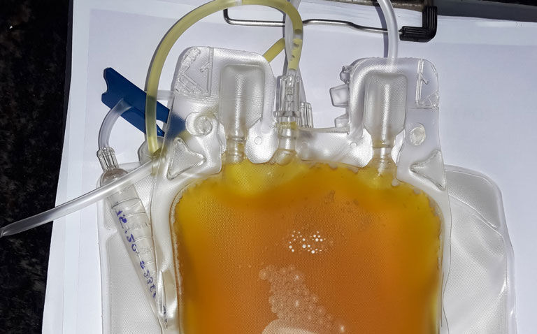 Convalescent plasma use reduces hospitalisation in unvaccinated COVID-19 patients