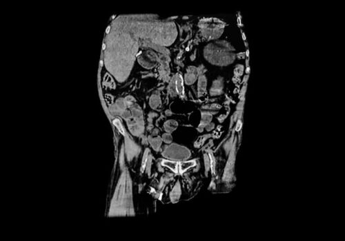 Could abdominal aortic calcification and troponin levels be prognostic for risk of ASVD in older women?|aortic calcification