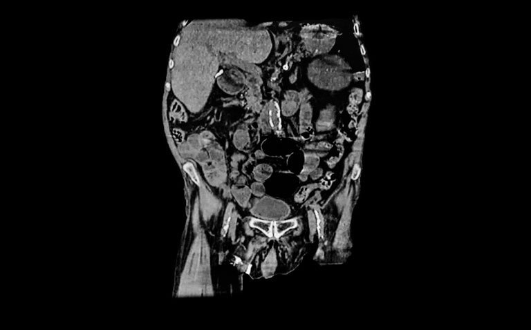 Could abdominal aortic calcification and troponin levels be prognostic for risk of ASVD in older women?|aortic calcification