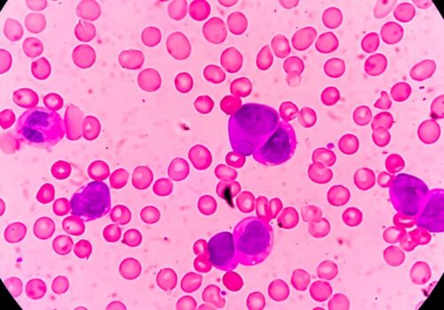 |ACUTE myeloid leukaemia
