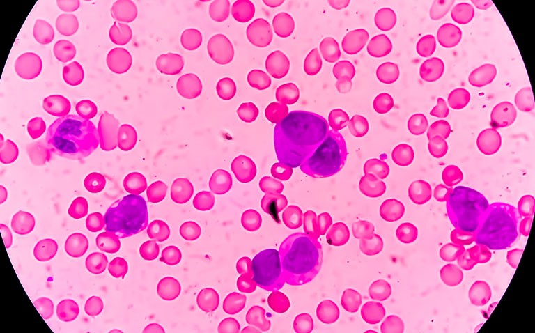 |ACUTE myeloid leukaemia