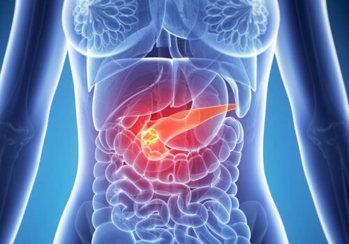 Deep learning-based tool detects pancreatic cancers missed on abdominal CT scan