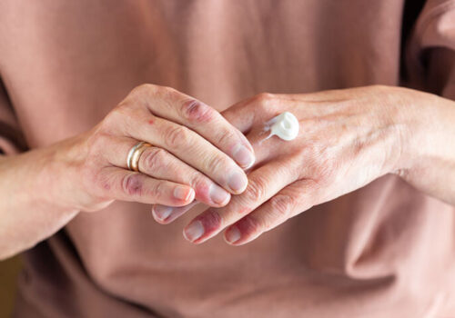 A close up of a woman applying cream to her hands to illustrate the fact that delgocitinib cream has been found to boost quality of life in chronic hand eczema