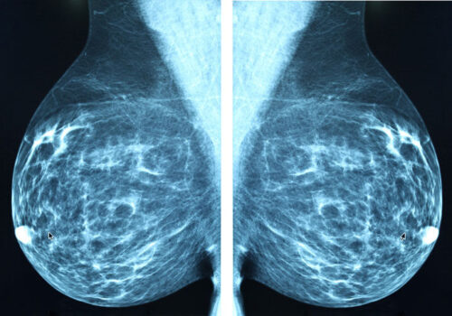 Dense breasts and benign disease on mammography linked to higher risk of future breast cancer in Asian women