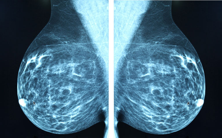 Dense breasts and benign disease on mammography linked to higher risk of future breast cancer in Asian women