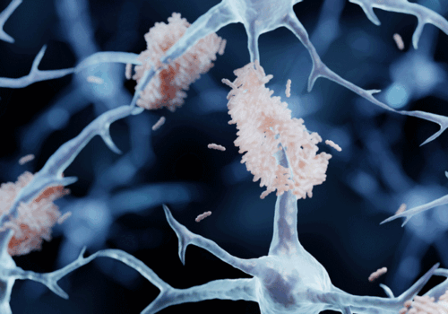 Donanemab provides greater brain amyloid clearance than aducanumab in early Alzheimer's