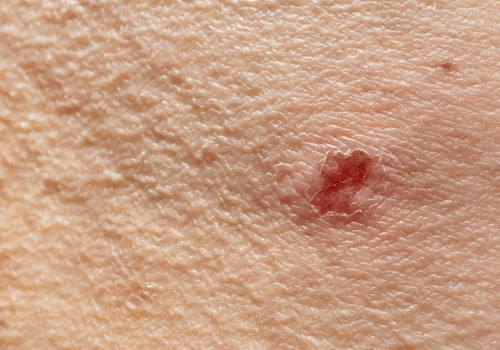 Dupixent recommended for EU approval to treat moderate to severe prurigo nodularis
