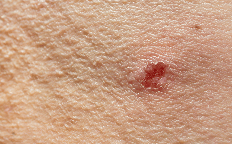 Dupixent recommended for EU approval to treat moderate to severe prurigo nodularis