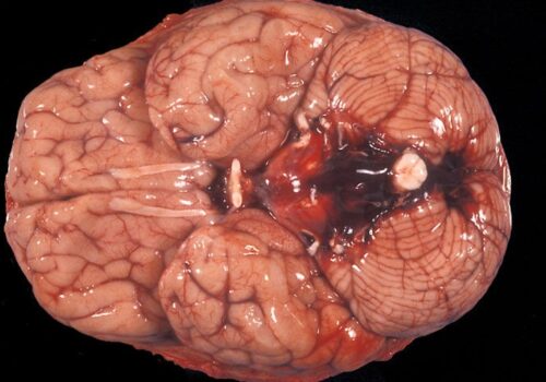 Early computed tomography best approach to rule out subarachnoid haemorrhage in sudden onset severe headache