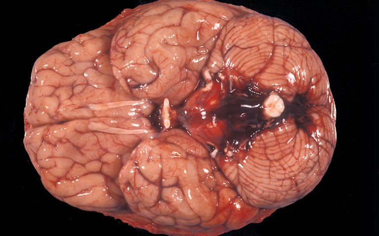 Early computed tomography best approach to rule out subarachnoid haemorrhage in sudden onset severe headache