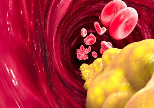 Elevated lipoprotein A levels positively associated with higher risk of prostate cancer