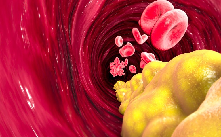 Elevated lipoprotein A levels positively associated with higher risk of prostate cancer