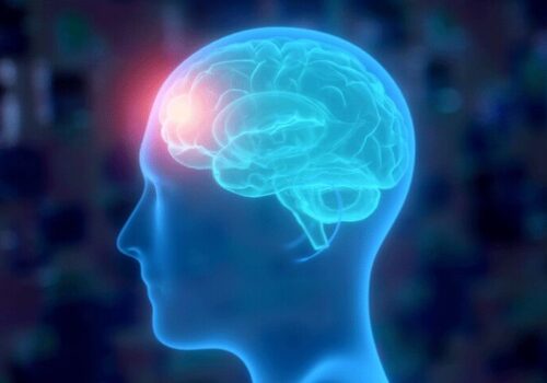 Enlarged perivascular spaces revealed by MRI in migraine sufferers|Enlarged perivascular spaces revealed by MRI in migraine sufferers