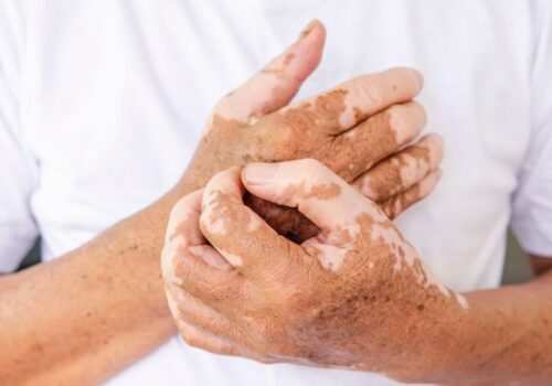 FDA approves ruxolitinib cream for vitiligo