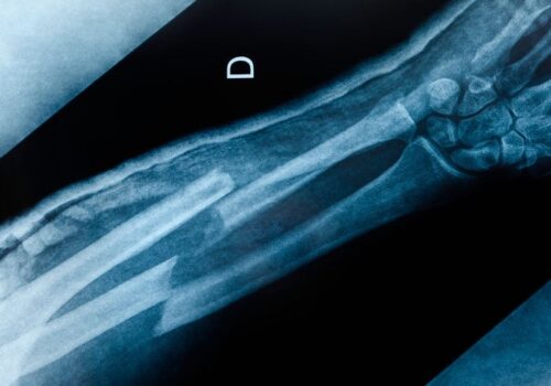 Fracture detection rates found to be comparable between AI and clinicians