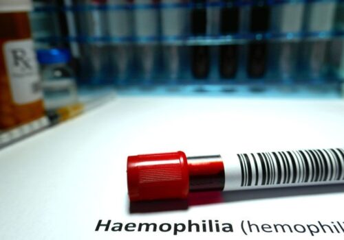 Gene therapy induces sustained and normalised levels of factor IX in haemophilia B