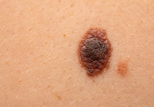 Relatlimab-nivolumab combination effective in metastatic melanoma