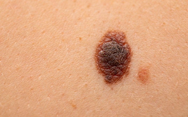 Relatlimab-nivolumab combination effective in metastatic melanoma