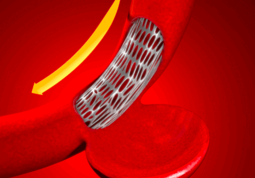 endovascular treatment