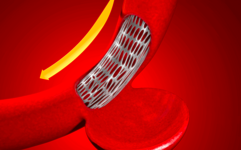 endovascular treatment