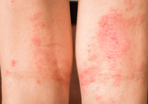 atopic eczema