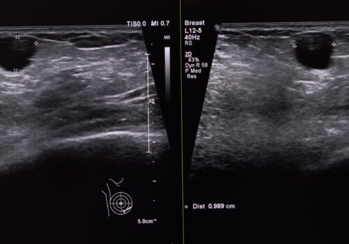 breast ultrasound