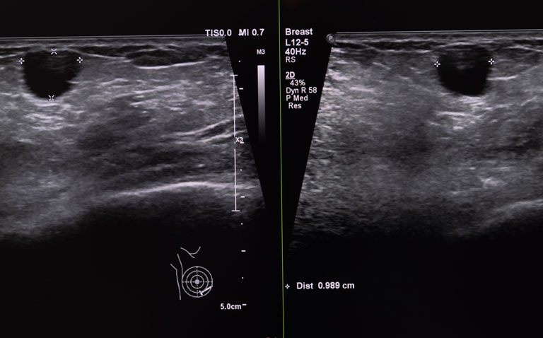 breast ultrasound