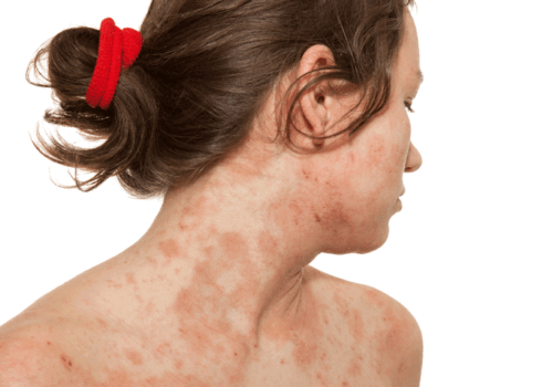 dupilumab and eczema