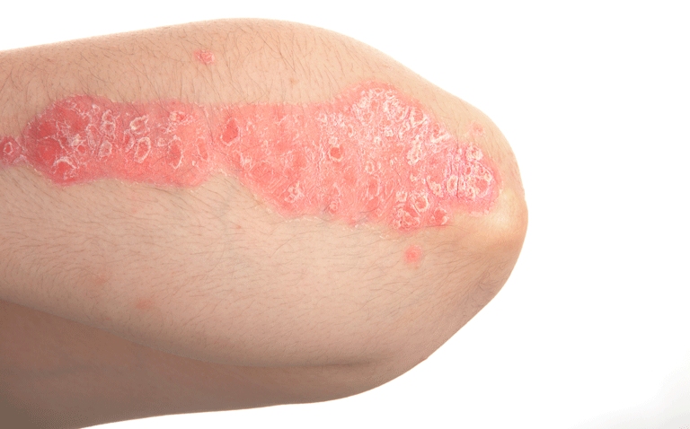 plaque psoriasis