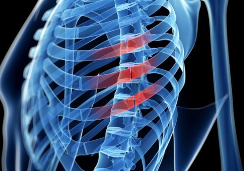 |Intrathoracic bleeding after rib fracture similar for DOACs and vitamin K antagonists