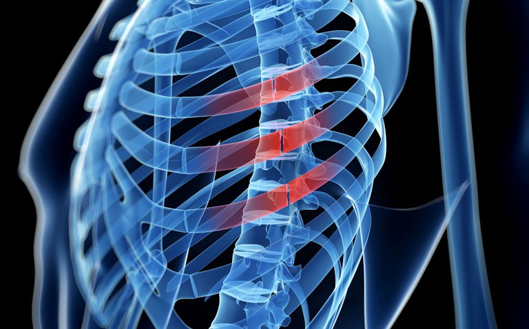|Intrathoracic bleeding after rib fracture similar for DOACs and vitamin K antagonists