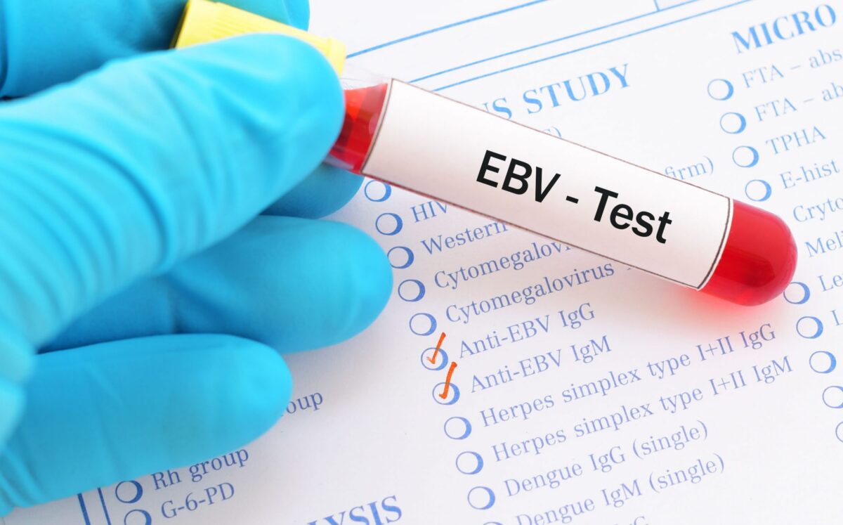 Epstein-Barr virus